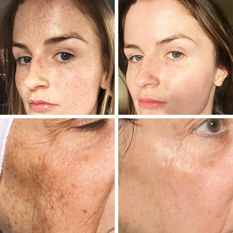 Dark Spots Remover Whitening Serum Face Freckle Melanin Correcting Reduce Fine Lines Brighten Essence Korean Beauty Skin Care