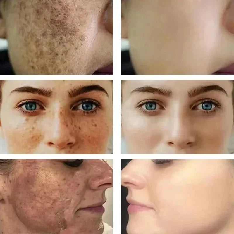 Dark Spots Remover Whitening Serum Face Freckle Melanin Correcting Reduce Fine Lines Brighten Essence Korean Beauty Skin Care